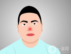 酒渣鼻不能做隆鼻手术的原因是什么