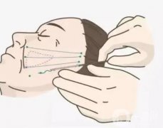 什么是电波拉皮？电波拉皮的作用有哪些