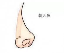 什么是朝天鼻，朝天鼻应该如何矫正呢