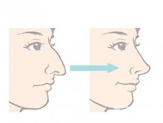 鹰钩鼻矫正有没有风险？风险有哪些