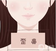 必须取出隆鼻假体的情况有哪些