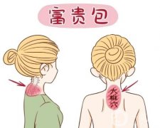 富贵包有哪些危险和影响，有什么方法快速消除