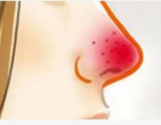 酒渣鼻调节后肿胀需要多长时间才能消退？