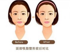 面部吸脂会导致皮肤松弛吗？需要注意哪些事项