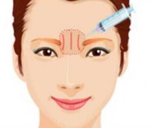 去除川字纹的方法有哪些？