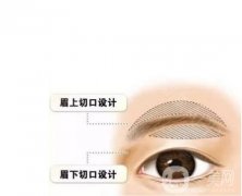 切眉有副作用吗？副作用有哪些