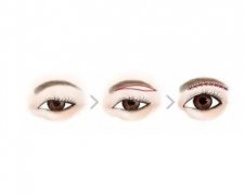 切眉要花多少钱？切眉手术后会留疤吗