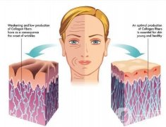 射频紧肤怎么样？射频紧肤效果如何？