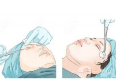 双眼皮手术失败如何修复？