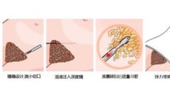 吸脂后穿塑身衣的作用是什么