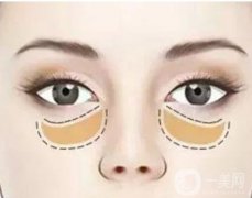 有哪些填充泪沟的方法？价格是多少
