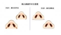 有哪些缩小鼻尖的方法？吸脂可以吗