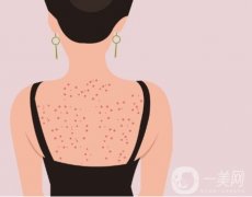 有哪些去除背部痘印的方法？