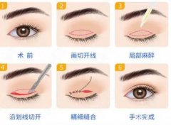 全切双眼皮和埋线双眼皮的区别揭秘，选择哪种更适合你？