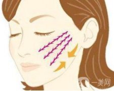 大V线提升的效果能维持多久，适合什么年龄