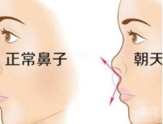 朝天鼻矫正很难矫正吗？矫正后多久可以洗脸