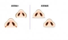 鼻孔缩小术的手术方法有哪些？痛吗