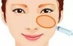 玻尿酸丰眼窝的优势有哪些，需要多少钱？