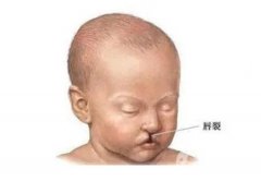 修复唇腭裂手术前后应注意哪些事项