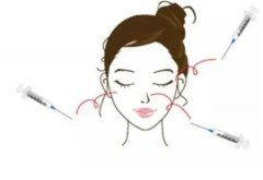 玻尿酸丰下巴好不好？玻尿酸丰下巴有什么优势