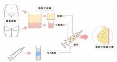 什么是自体脂肪填充面部？适合哪些情况？