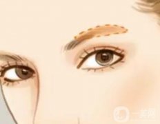 什么是眉弓？微眉整形的优点和缺点是什么？