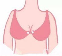 什么是假体隆胸？优点和缺点有哪些？