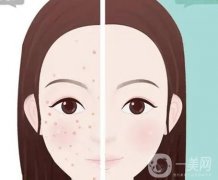 哪些人不适合光子嫩肤，应注意哪些事项