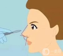 膨体隆鼻手术安全吗，隆鼻后需要多久才能软化