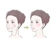 射频紧肤有效吗？哪些人适合射频紧肤