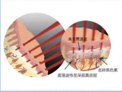 皮秒祛斑效果好吗？为什么做皮秒后皮肤很干