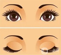 纳米无痕双眼皮和全切双眼皮的区别