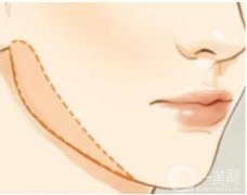 切骨瘦脸能达到哪些效果？会出现哪些并发症