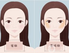 祛黄褐斑做皮秒可以吗？哪些人适合