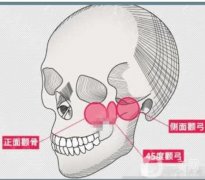 什么是截骨？哪些人适合做截骨术