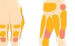 大腿环吸后要注意什么？