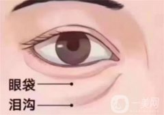 溶脂去眼袋有危害吗？哪些人群适合