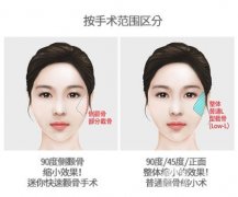 颧骨缩小手术方法有哪些