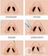 鼻翼缩小术有哪些危害