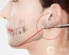 骨整形手术安全吗，需要多少钱