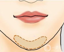 假体垫下巴要多少钱？