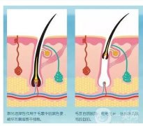 鸡皮可以用激光去除吗？