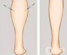 大腿环吸后肿胀怎么办，要几天才能恢复