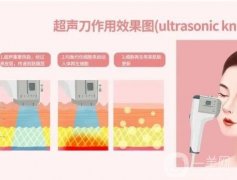 超声刀后注射玻尿酸需要多长时间