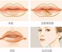 丰唇的方法有哪些呢