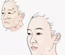 让面部年轻化的方法有哪些？