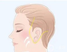 去除副耳有危险吗，如何去除副耳