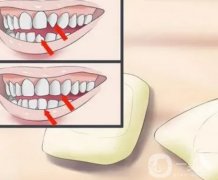 如果烤瓷牙有缝隙怎么办？
