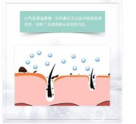 小气泡有哪些优点和缺点？