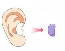 耳软骨垫鼻尖有什么风险和后遗症